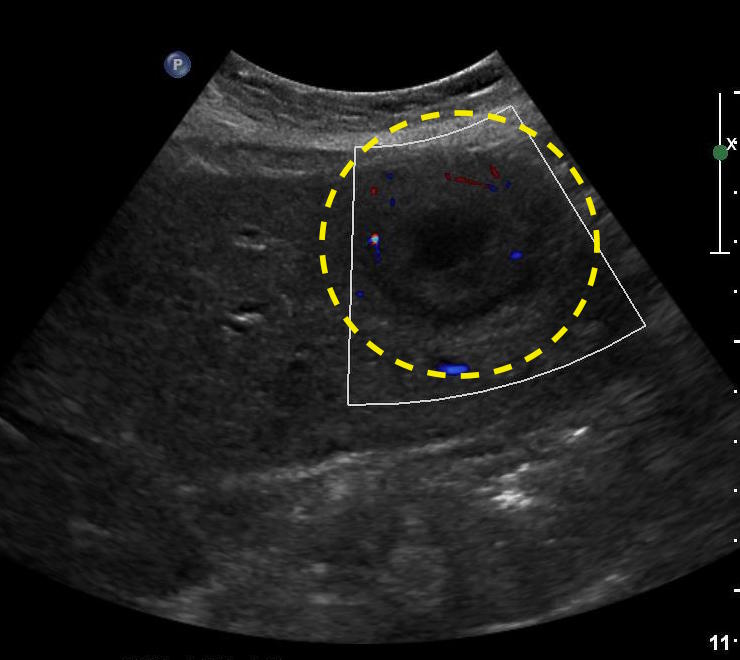 Liver mass Ultrasound wikidoc