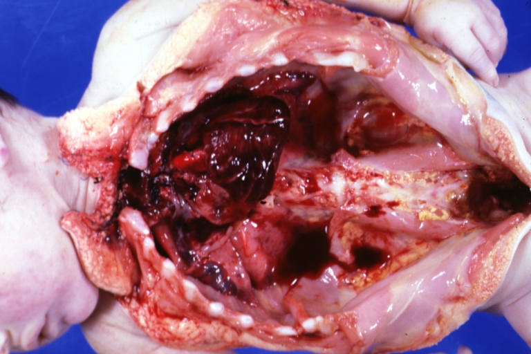 Hemorrhagic Necrosis; Massive, Postoperative: Gross; natural color, heart, in situ, a 2 day old infant, operative death, interrupted aortic arch and VSD (Image courtesy of Professor Peter Anderson DVM PhD and published with permission © PEIR, University of Alabama at Birmingham, Department of Pathology)