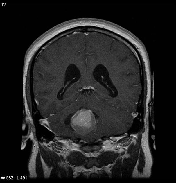 Brain MRI T1 with contrast image demonstrates a vividly but heterogeneously enhancing mass in the right side of the 4th ventricle is associated with significant surrounding edema and mass effect. There is ventricular enlargement consistent with non-communicating hydrocephalus.[17]