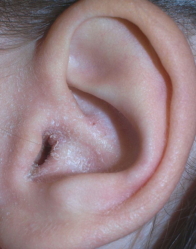 A mild case of otitis externa. Case presented by Klaus D. Peter.