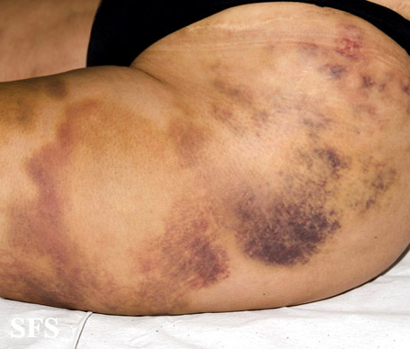 File:Painful bruising syndrome04.jpg