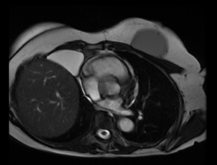 Cardiac MRI: Pericardial cyst