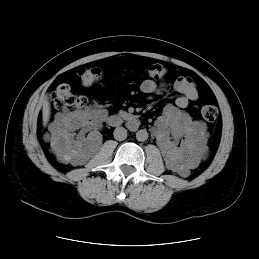 File:Polycystic-kidneys-002.jpg