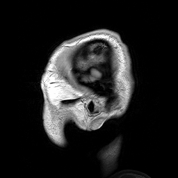 Para-sagittal MRI of the head in a patient with benign familial macrocephaly prior to aneurysm.