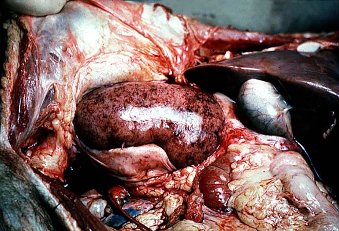 This is a gross photograph of a kidney with acute rejection from an autopsy case. Note that the kidney is swollen (edema and inflammation) and there are areas of hemorrhage throughout the kidney.
