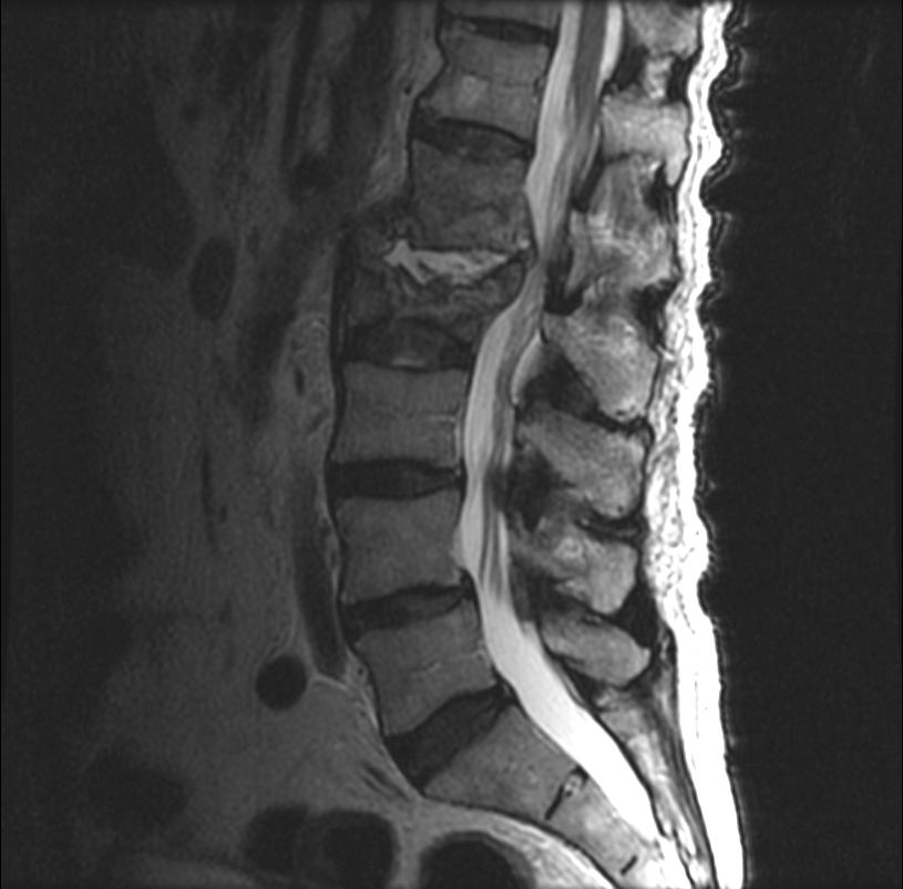 MR image demonstrates lumbar spinal discitis/osteomyelitis