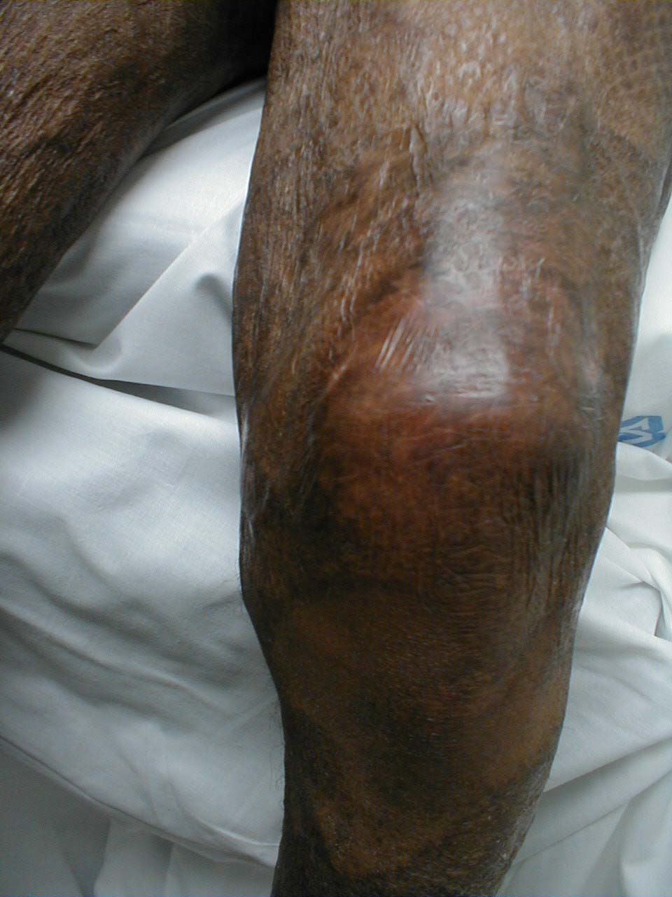 Picture demonstrates normal knee for comparison. skin changes seen in both legs are related to burns that patient suffered previously.