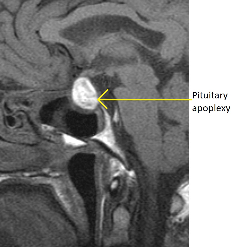 File:Pituitary-apoplexy-marked.jpg