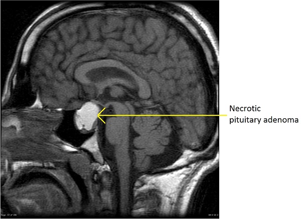 MRI showing necrotic pituitary adenoma(Source: Case courtesy of A.Prof Frank Gaillard, Radiopaedia.org, rID: 17664
