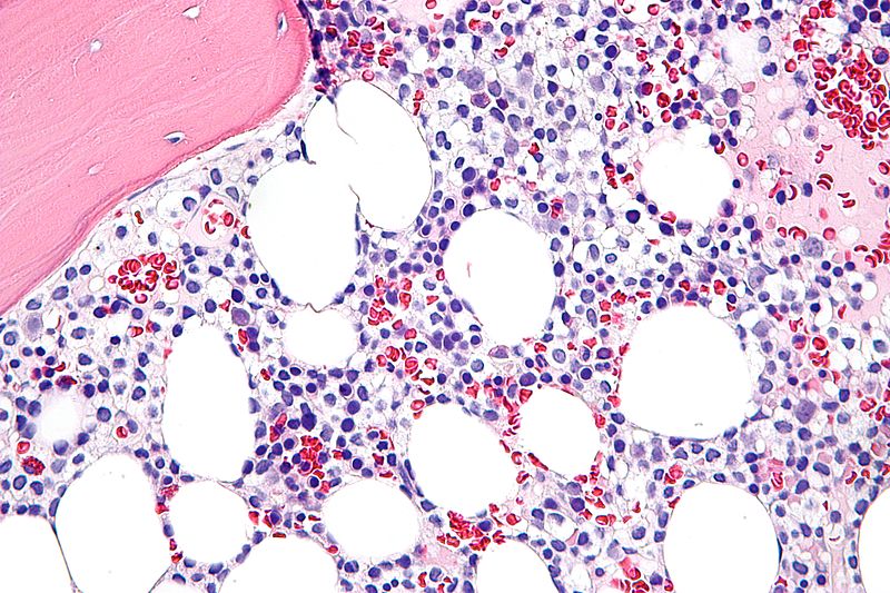File:800px-Hairy cell leukemia - very high mag.jpg