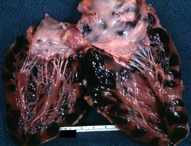 Heart in metastatic melanoma.