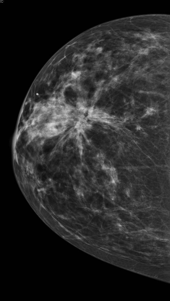Woman undergoing mammogram