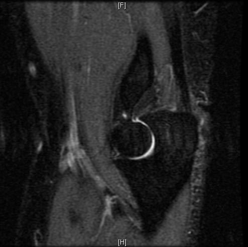 File:Normal-elbow-MRI-006.jpg