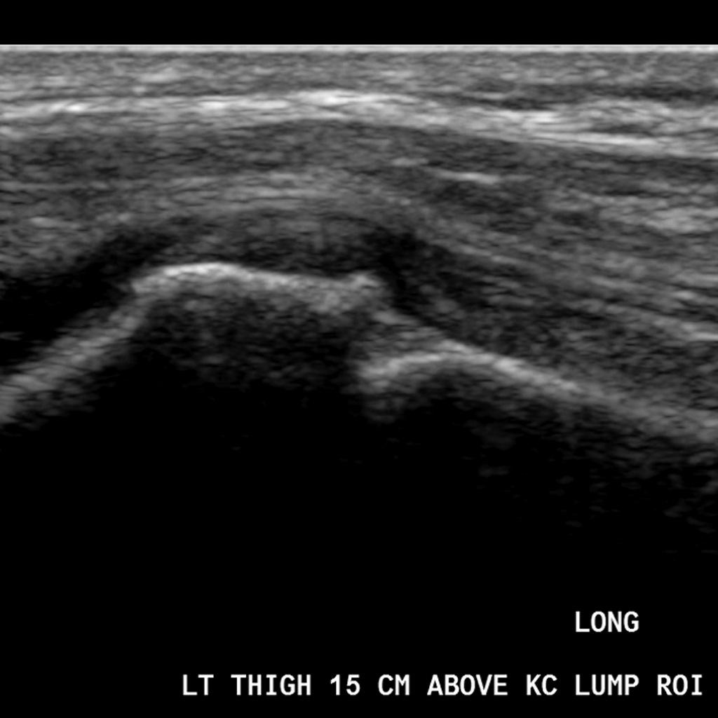 Image shows a hypoechoic layer that corresponds with the osteochondroma cartilage cap.