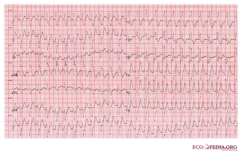 File:Wide complex tachycardia 1.jpg