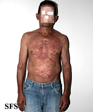 Borderline leprosy. Adapted from Dermatology Atlas.<ref name="Dermatology Atlas">{{Cite