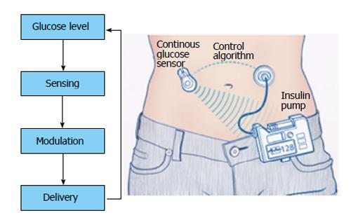Closed-Loop Insulin Delivery System