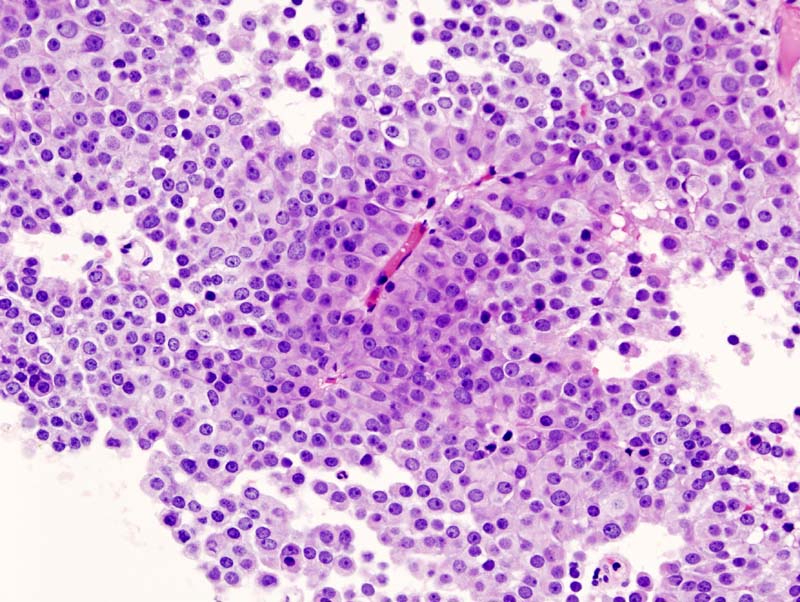Histopathological image of nonfunctioning pituitary adenoma. Hematoxylin & eosin stain showing basophilic appearance of the cells.
