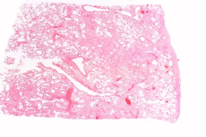 This is a low-power photomicrograph of lung from this case. The lung section has a pale-red color indicating proteinaceous material within the lung.