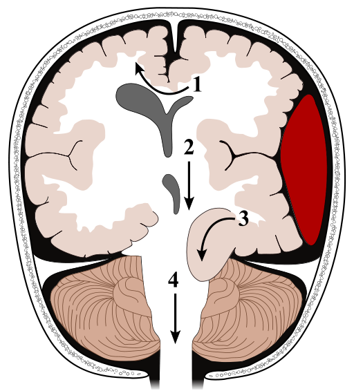 File:512px-Brain herniation types.svg.png