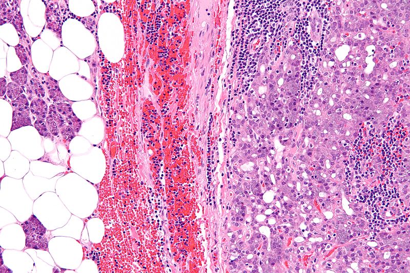 File:Acinic cell carcinoma01.jpg
