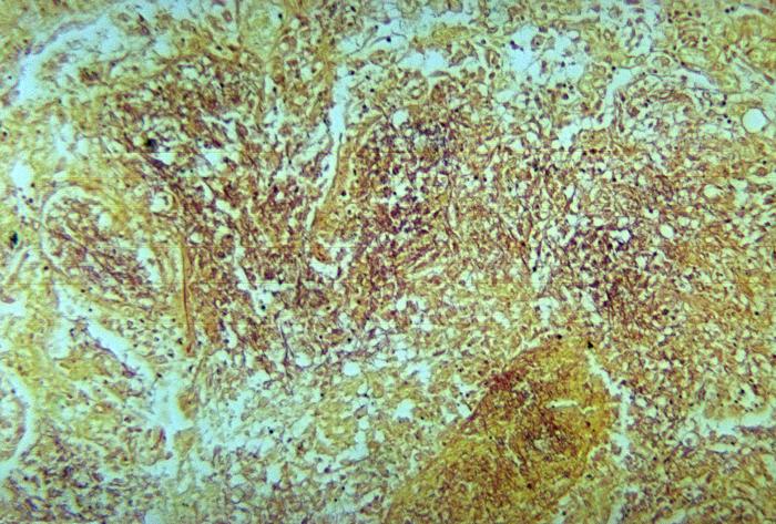 Histopathologic changes associated with nocardiosis of the lung using a Brown and Brenn stain. From Public Health Image Library (PHIL). [1]
