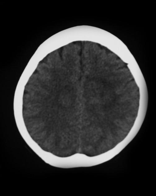 Single image from a non-contrast CT scan demonstrating a vague bilateral hyperdensity crossing the midline.[3]