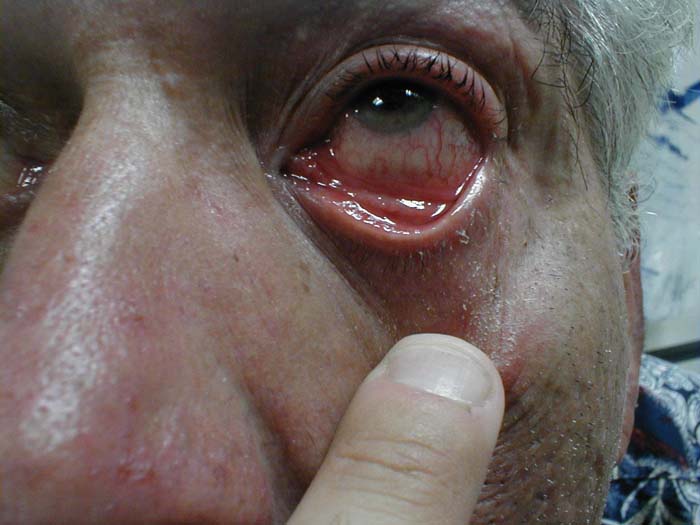 Conjunctivitis: Inflammation of conjunctiva covering sclera and under surface of eyelid.