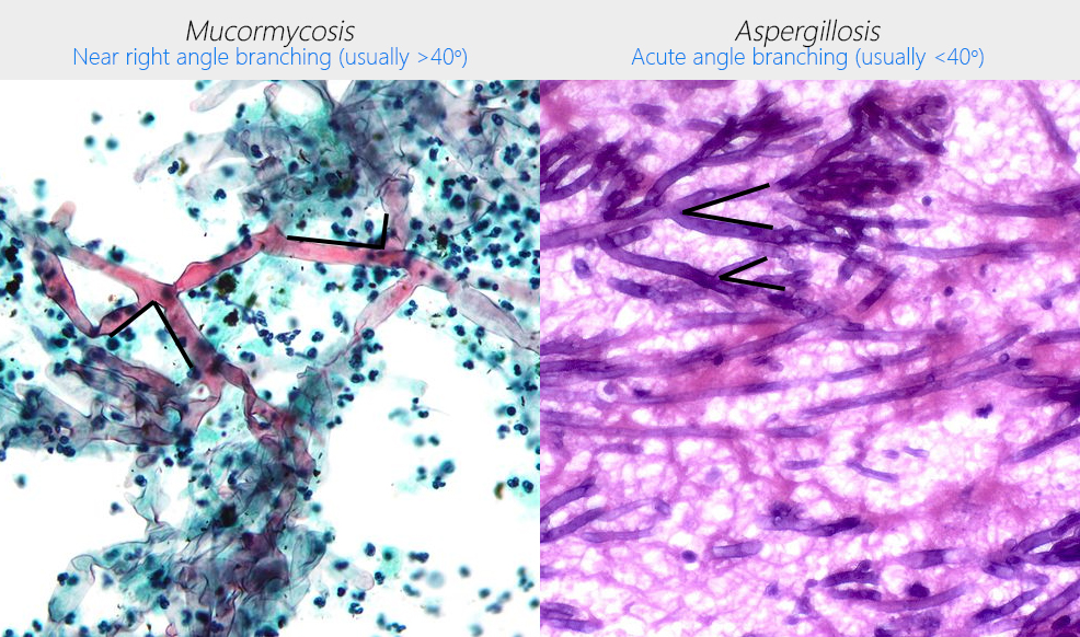 File:Mucor vs aspergillus.jpg