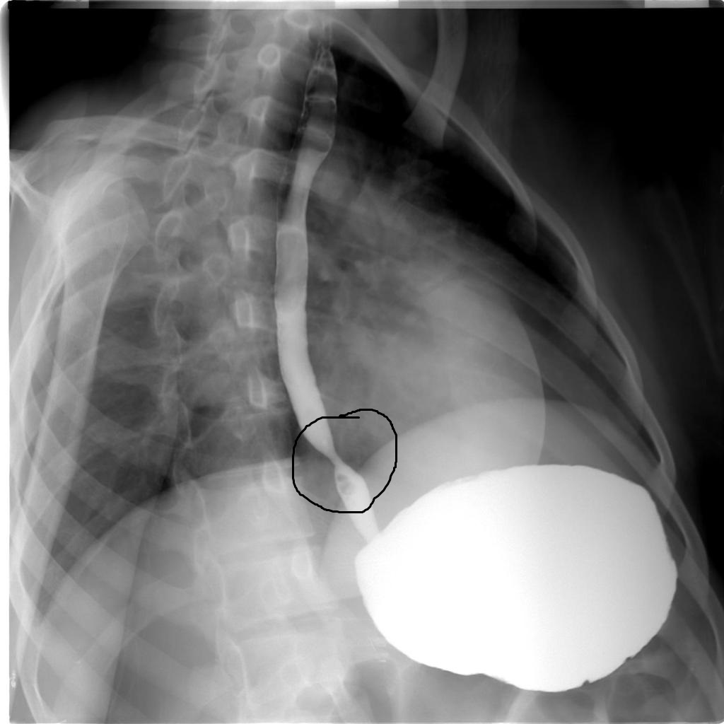 File:Peptic stricture1.jpg