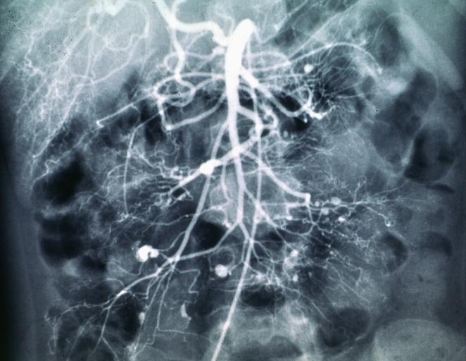 Polyarteritis nodosa mesenteric artery arteriogram