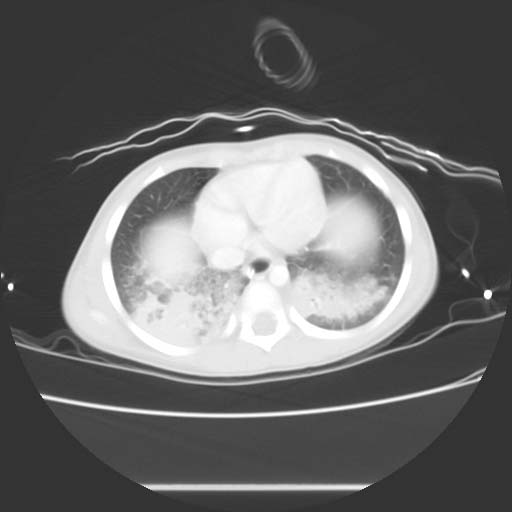 CT image demonstrates bilateral pulmonary contusions