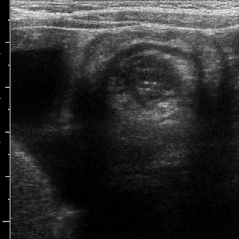 File:Intussusception-3.jpg