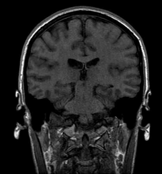 File:Mesial temporal sclerosis 001.jpg