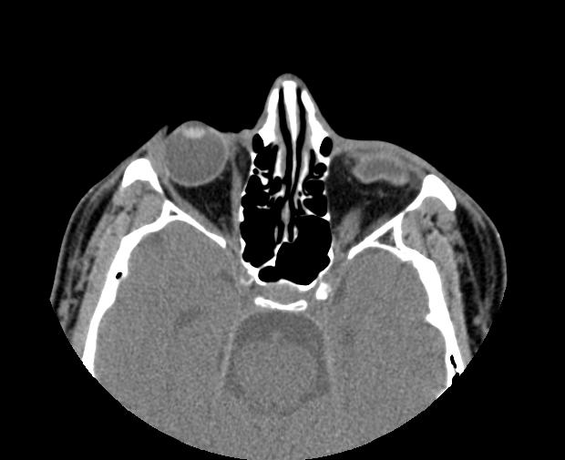 CT demonstrates a ruptured globe Image courtesy of RadsWiki and copylefted