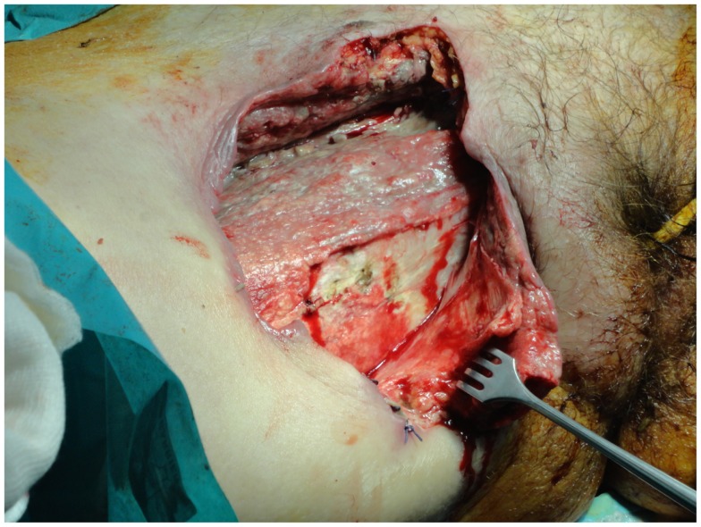 Surgery of necrotizing fasciitis.The excision of the necrotic tissues should extend until healthy tissue is found, but should be limited to the edges of the infection.[1]