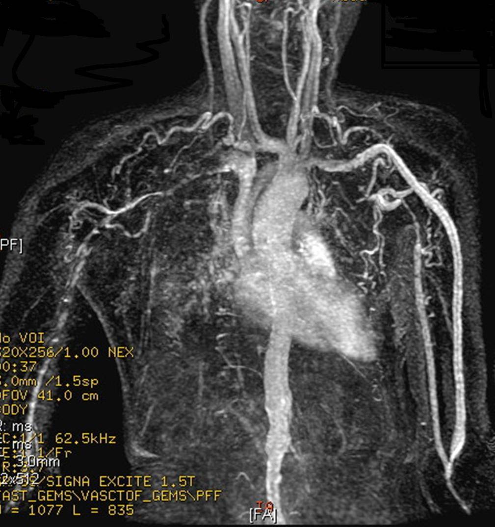 This MR angiogram demonstrates findings typical of Takayasu arteritis. A 32 years old Asian female has CRF and weak functioning iatrogenic fistula in left upper limb. The cause of malfunction can be explained by narrowing and occlusion of upper limb arteries. Notice also narrowed abdominal aorta. (Image courtesy of Dr Ahmed Haroun)