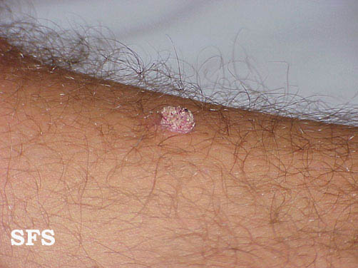 Warts vulgaris. Adapted from Dermatology Atlas.[1]