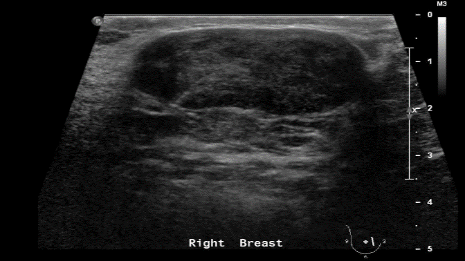 File:Breast fibroadenoma.gif