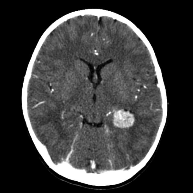 The mass is relatively well circumscribed, slightly hyperdense compared to grey matter on CT, and following administration of contrast demonstrates vivid enhancement.[15]