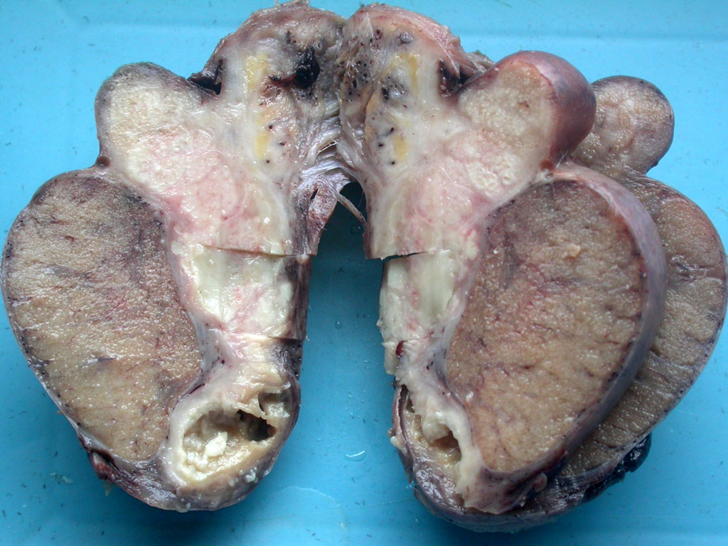 Cut-section through the testicle following orchidectomy showing a lesion in the epidydimis with fibrosis and caseous necrosis, following chronic epididymoorchitis caused by Mycobacterium tuberculosis. Adapted from https://commons.wikimedia.org/wiki/Category:Gross_pathology_of_tuberculous_epididymo-orchitis#/media/File:Tuberculous_epididymoorchitis_gross_pathology.jpg. Accessed on Jan 3rd, 2017.