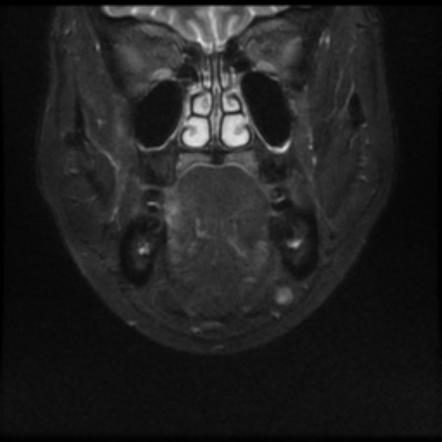 Coronal T2 fat saturated MRI of squamous cell carcinoma[5]