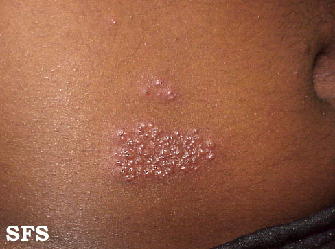 File:Herpes zoster 05.jpeg