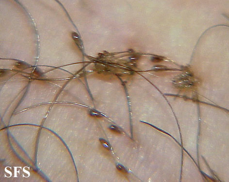 Pediculosis pubis. Permission from Dermatology Atlas.[7]