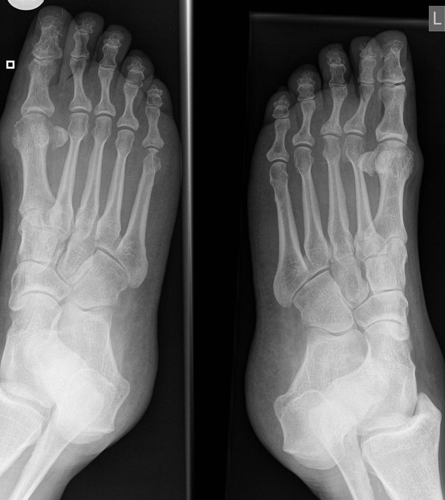 File:Rheumatoid-arthritis-feet.jpg