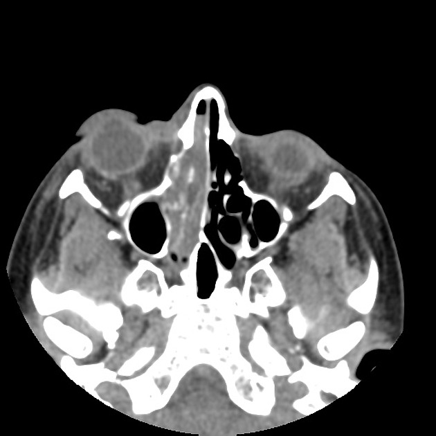 Axial non contrast CT of esthesioneuroblastoma [2]