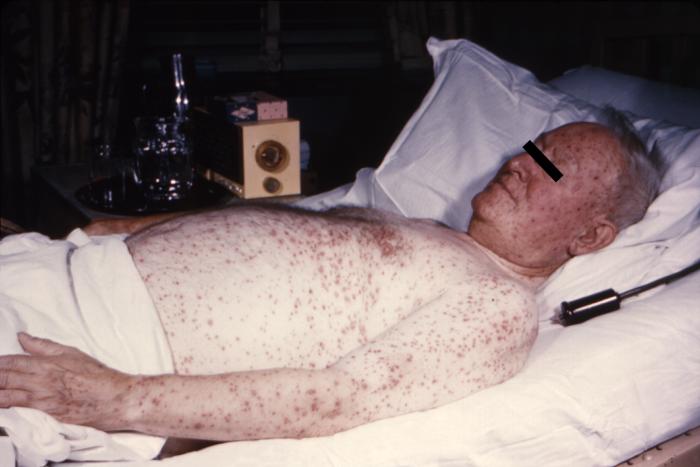 Case of chickenpox. From Public Health Image Library (PHIL). [2]