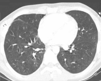 This CT scan, taken 22 days after pulmonary contusion with major chest trauma, shows that the contusion has completely resolved.