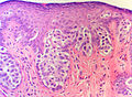 Anus Pagets Disease - (SKB)