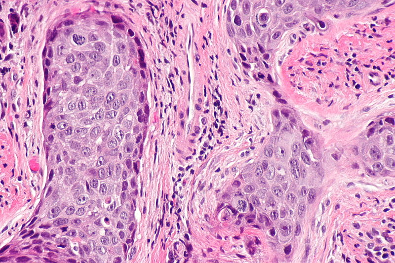 File:800px-Laryngeal squamous carcinoma -- high mag.jpg